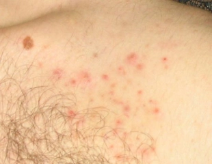 Göğüste Kıl Dönmesi Belirtileri ve Tedavisi