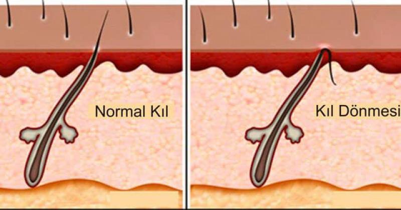Kasıkta Kıl Dömesi Belirtileri ve Tedavisi