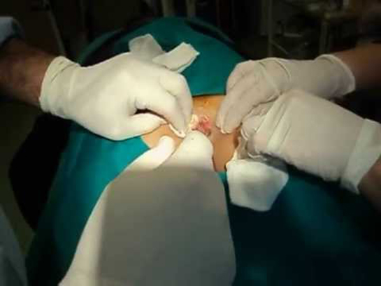 Kıl Ameliyatı Riskleri ve Sonrası