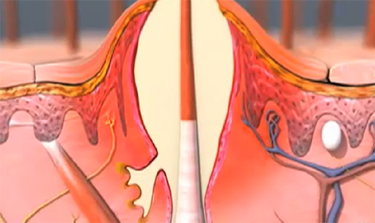 Kıl Dönmesi İltihabı Belirtileri ve Tedavisi